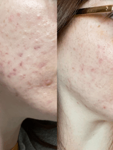 Side-by-side before-and-after images of a woman with fair skin showing reduced under-the-skin acne, diminished redness, and fewer acne marks after a holistic skin improvement.