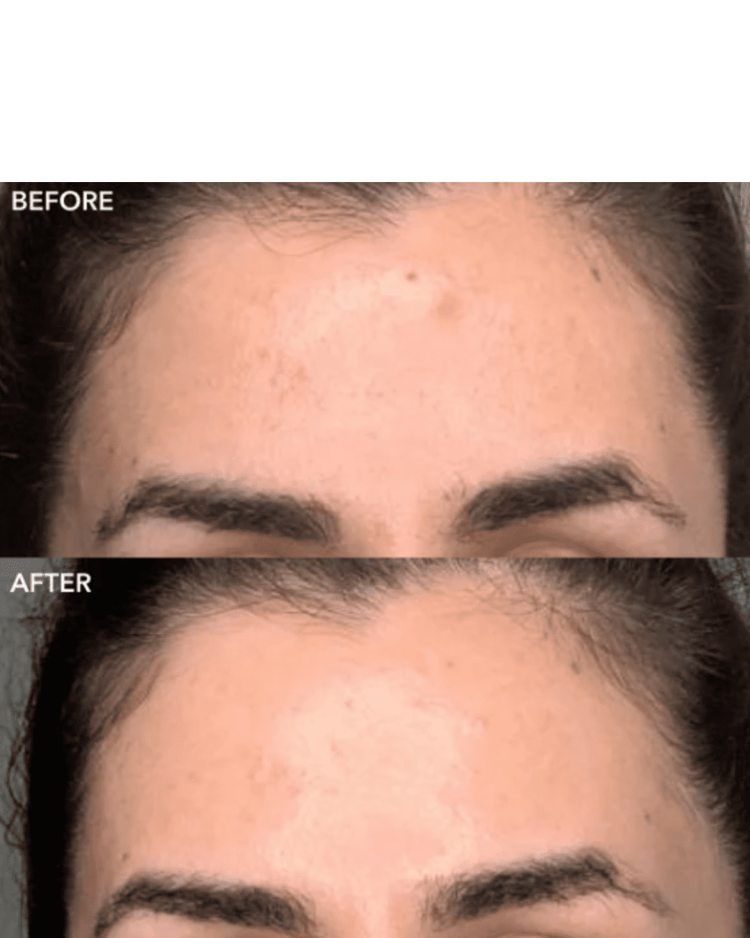 Algenist’s BHA Toner before and after results with congested skin