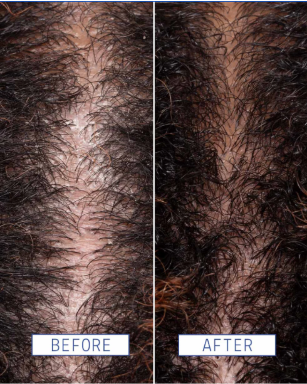 Before and after comparison of scalp using AAVRANI’s Scalp Detox Jelly Cleanser, showing flakes and dandruff before, and a clean, healthy scalp after treatment.