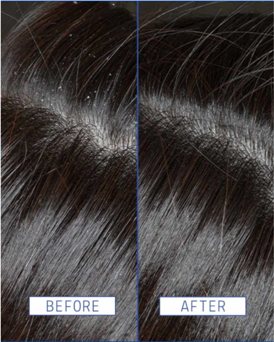 Close-up of a woman's black hair showing flakes before using AAVRANI’s Scalp Rescue Serum, and a clean, hydrated scalp after treatment.