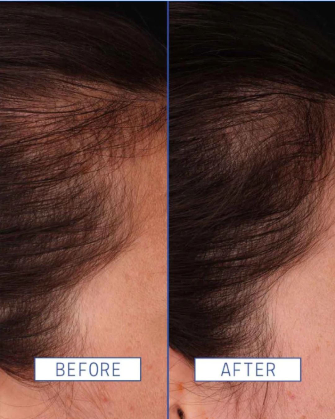 Before-and-after comparison of a woman's hair using the AAVRANI’s Hair Density Boosting Treatment, showing visibly fuller, healthier hair after use.