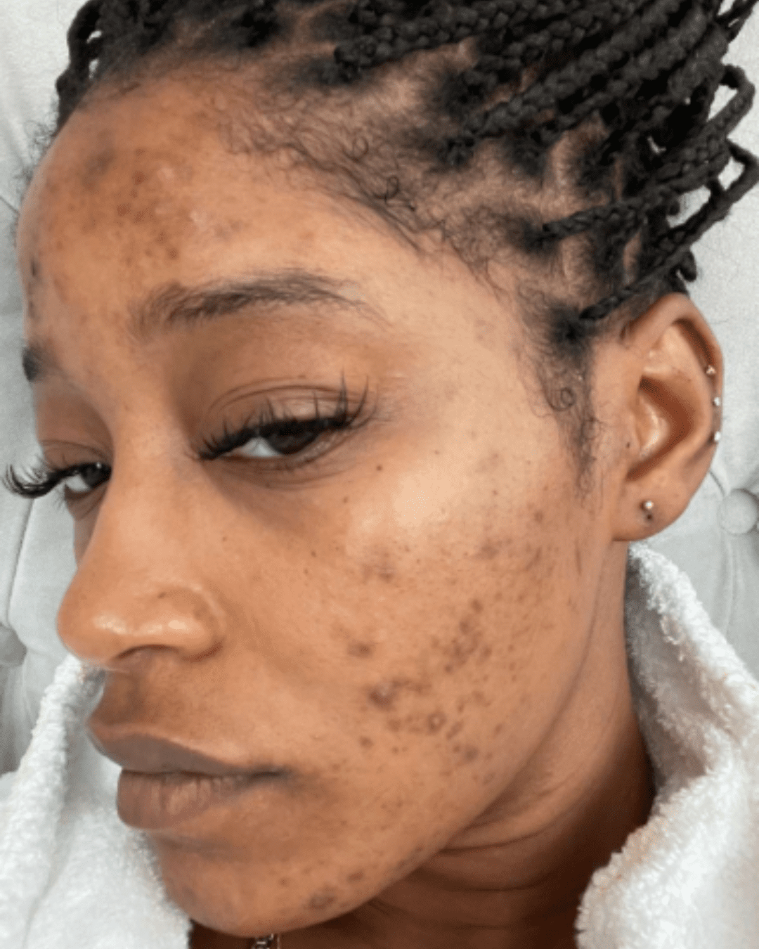 Keke Palmer PCOS showing her real skin.