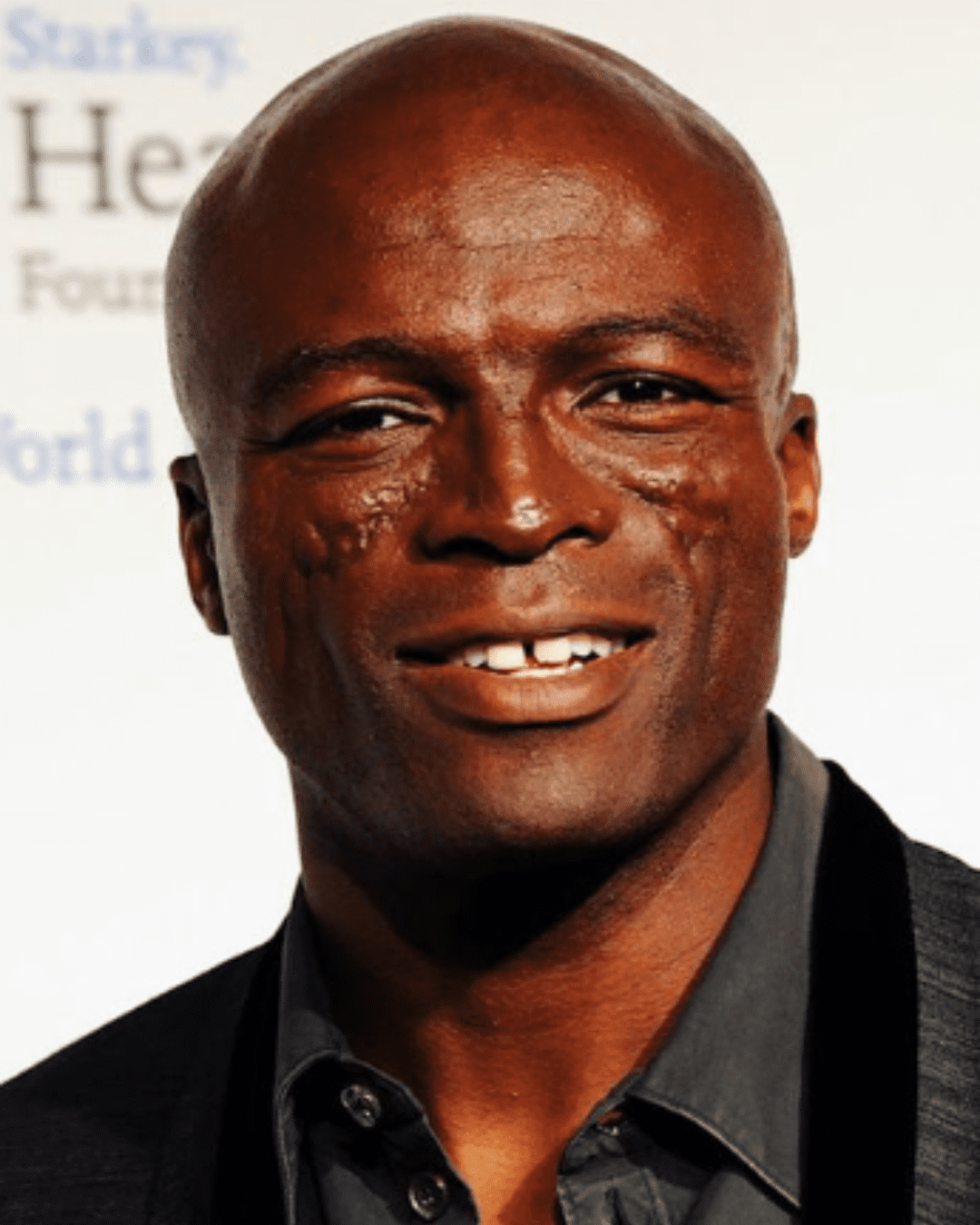 Seal with his lupus scars showing his real skin.