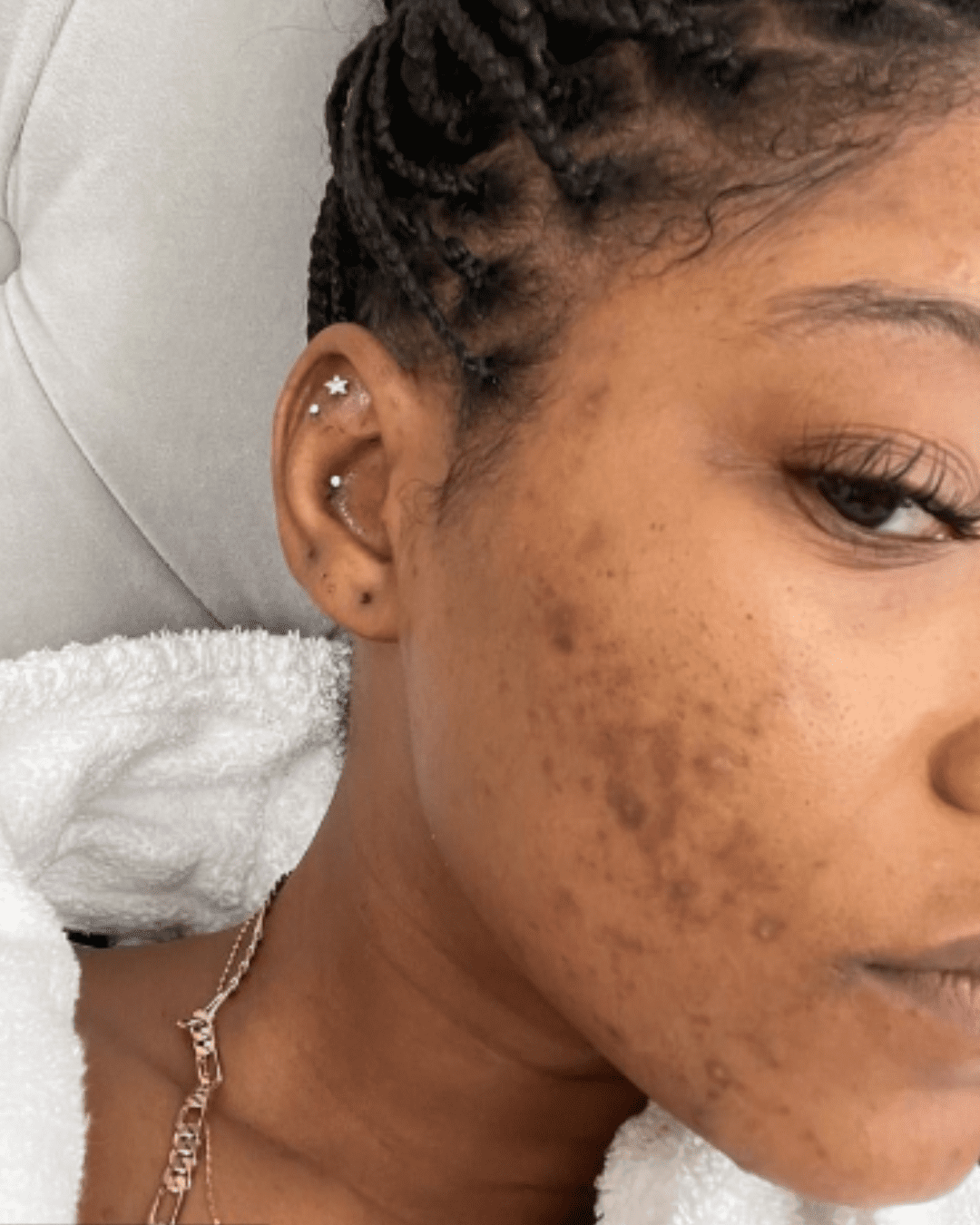 Keke Palmer PCOS showing her real skin.
