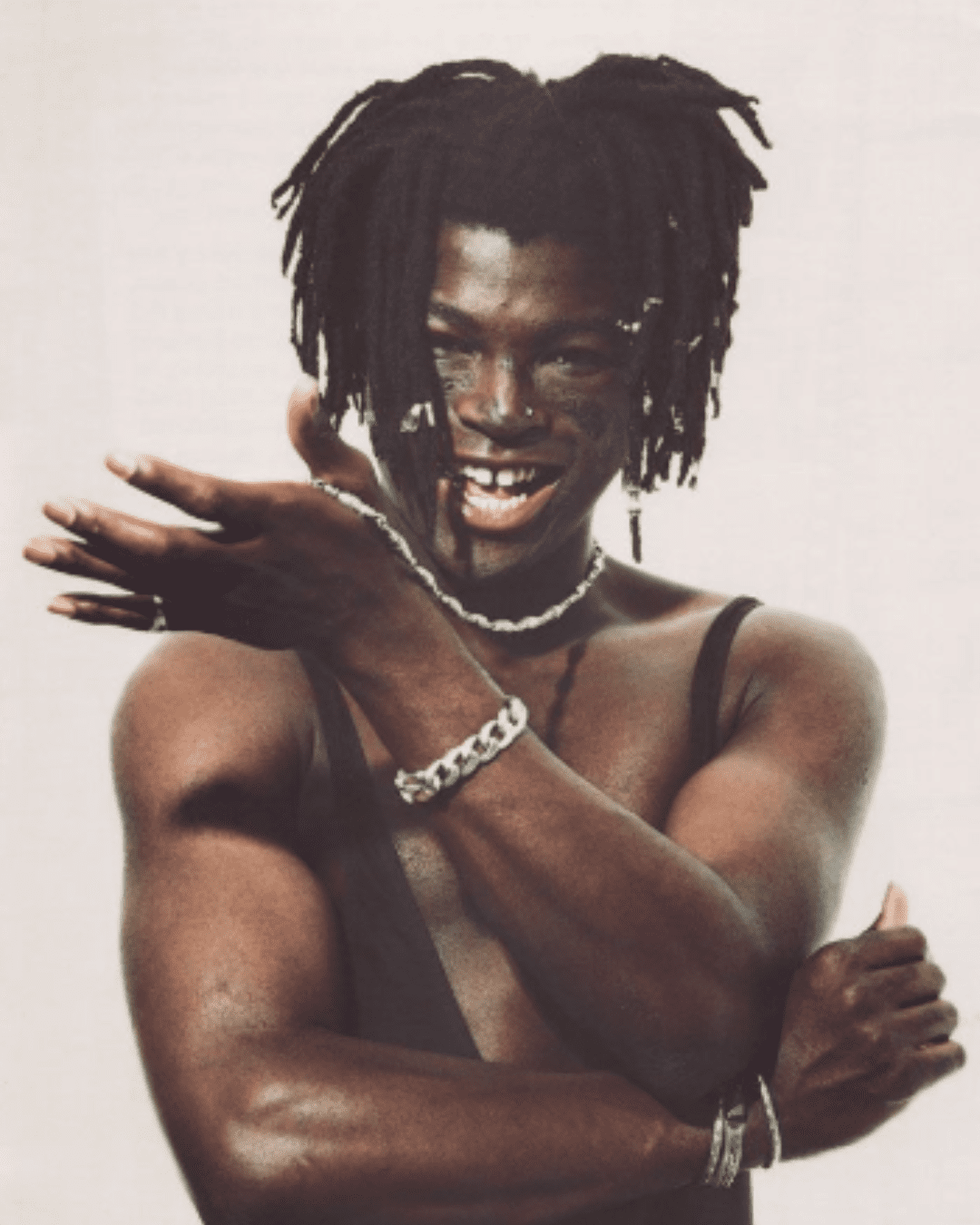 Seal before his lupus scars showing his real skin.