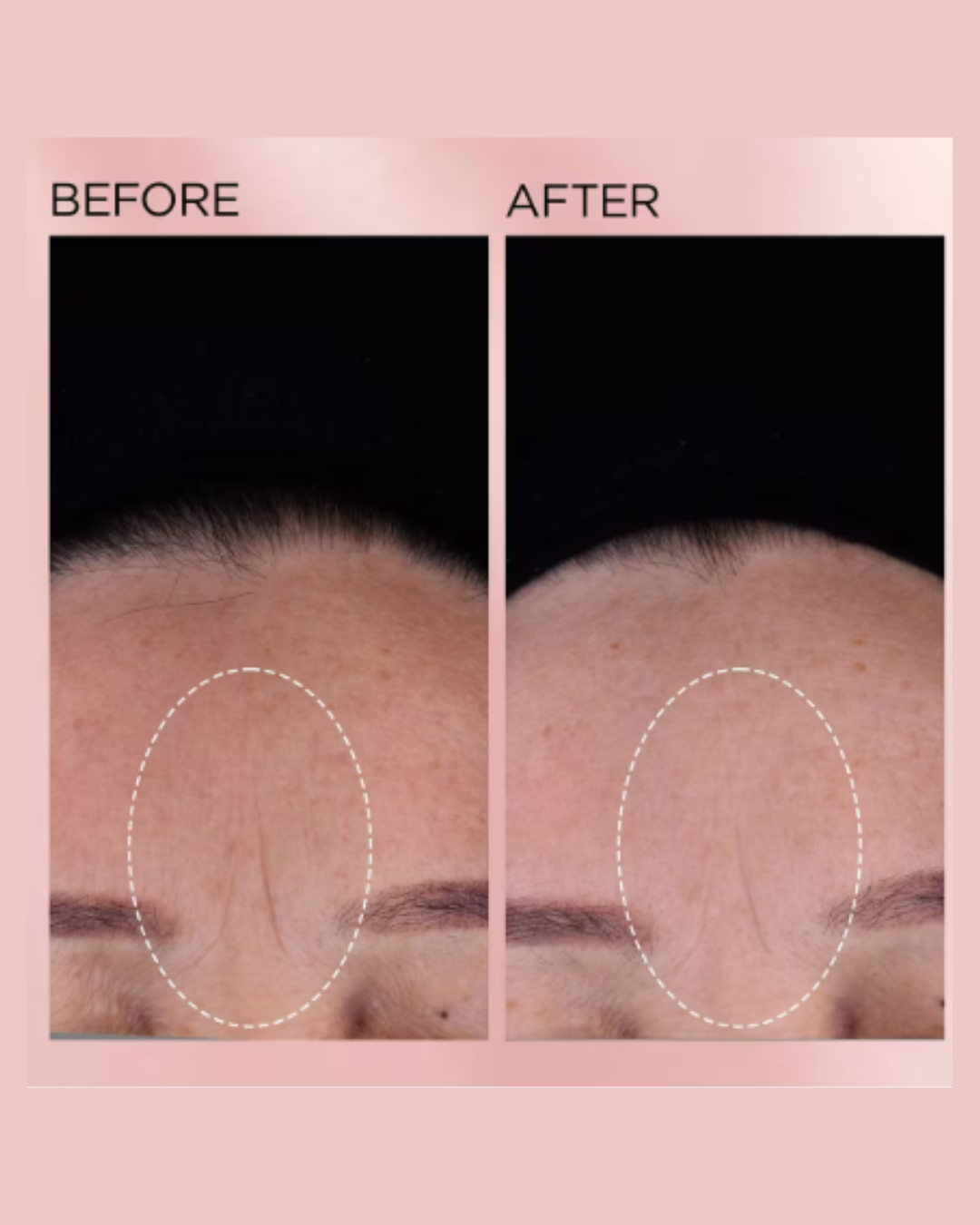 Retinol + HPR Ceramide Capsules Rapid Skin Renewing Serum