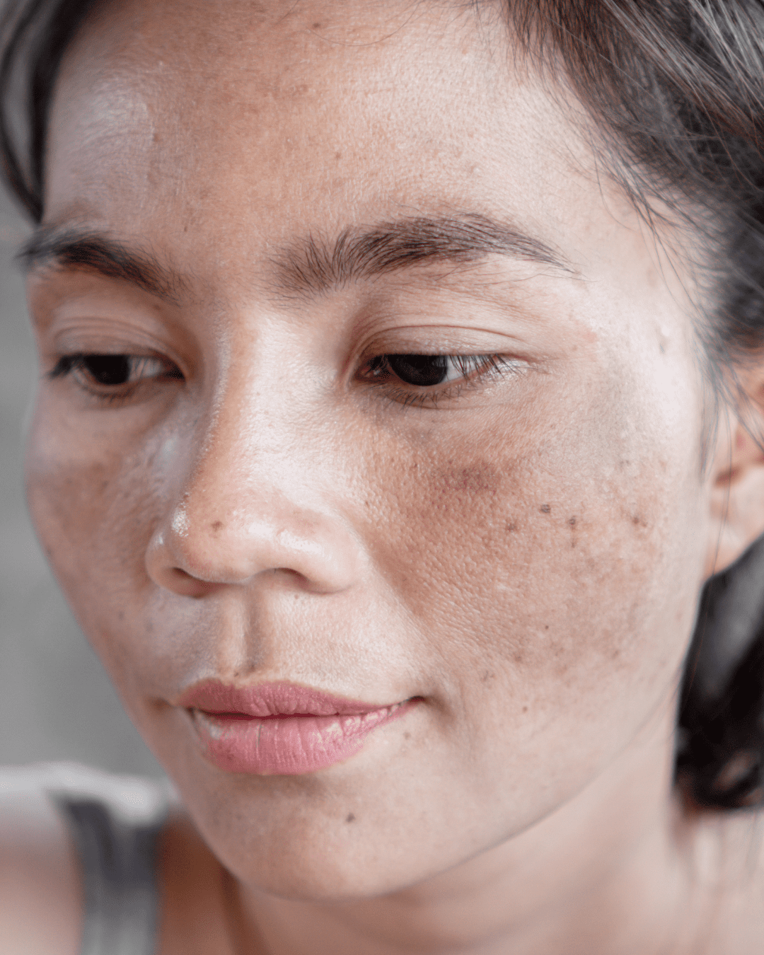 Woman in a gray tank top looking to the side, showing sun-damaged skin on her forehead and cheeks, highlighting the importance of skincare and fruit-based remedies in supporting skin health.