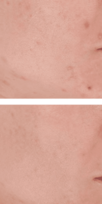 Before-and-after comparison of a person with fair skin using LightStim Blue Light Therapy. The top image shows acne scars and blemishes, while the bottom image shows clearer, smoother skin after treatment.