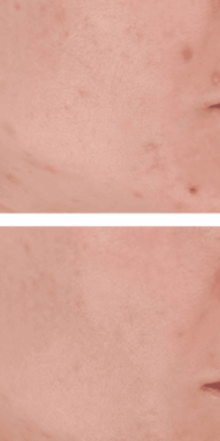 Before-and-after comparison of a person with fair skin using LightStim Blue Light Therapy. The top image shows acne scars and blemishes, while the bottom image shows clearer, smoother skin after treatment.