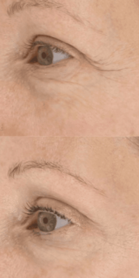 Before-and-after comparison of an older white woman's face using LightStim red light therapy. The top image shows visible crow's feet and fine lines, while the bottom image shows the same woman with noticeably reduced wrinkles and smoother skin.